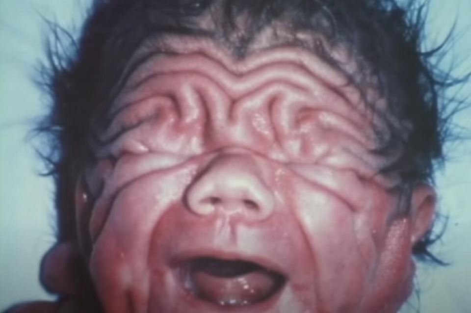 Kako danas izgleda Tom koji je rođena sa kožom Šar peja: Na rođenju je imao toliko kože da mu se lice nije videlo