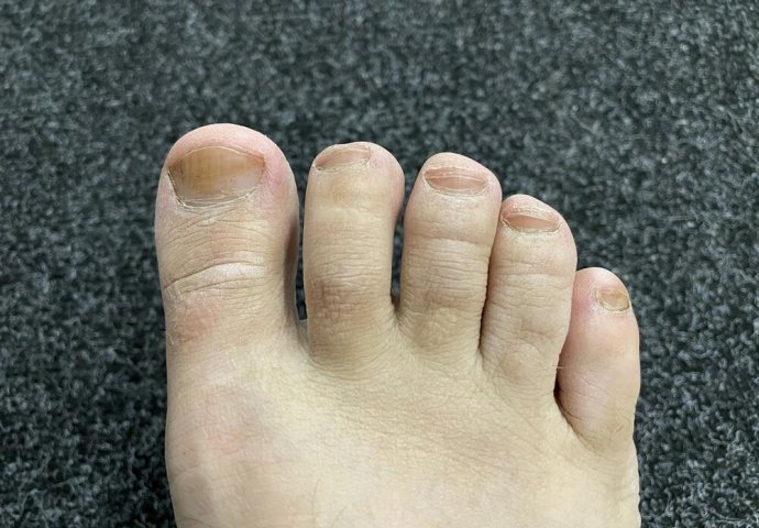 IMATE LI GLJIVICE I ŽUTE, ZADEBLJALE NOKTE: Samo namažite ovo ulje i riješit ćete problem preko noći - featured image