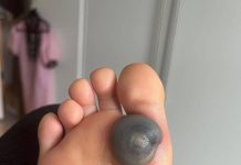 Jutros sam se probudila sa velikim podljevom na stopalu i ne znam šta bi to moglo biti. Ima bolove i ne može da pomjeri stopalo, šta je ovo? Objasnite ovo 😩…