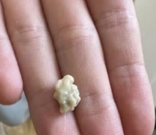 “Neočekivano i šokantno iskustvo: Ono što je izašlo iz mog grla će vas ostaviti bez riječi 😳”