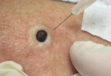 ŽENA JE GAJILA OVO NA LEĐIMA: Kada je doktorka uzela špric i bocnula, shvatit ćete zašto je SNIMAK pregledalo 33 miliona ljudi! ŽENA JE GAJILA OVO NA LEĐIMA: Kada je doktorka uzela špric i bocnula, shvatit ćete zašto je SNIMAK pregledalo 33 miliona ljudi! - featured image