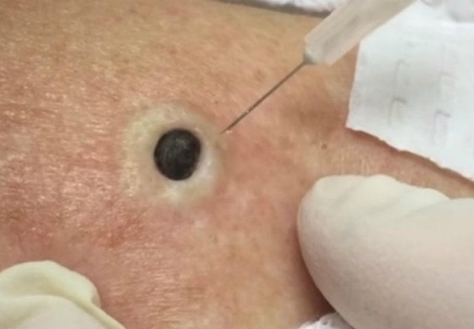 ŽENA JE GAJILA OVO NA LEĐIMA: Kada je doktorka uzela špric i bocnula, shvatit ćete zašto je SNIMAK pregledalo 33 miliona ljudi! - featured image