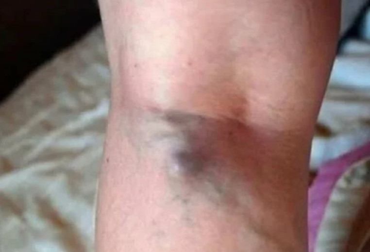 NAMIRNICE KOJE POVEĆAVAJU RIZIK OD TROMBOZE, JEDNA POSEBNO: Jedemo ih svakoga dana, a štete arterijama - featured image NAMIRNICE KOJE POVEĆAVAJU RIZIK OD TROMBOZE, JEDNA POSEBNO: Jedemo ih svakoga dana, a štete arterijama - featured image