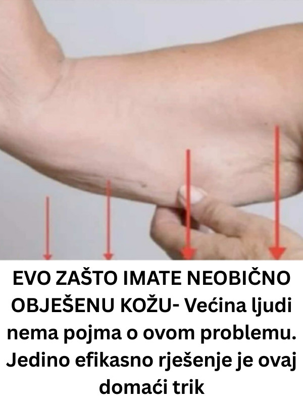 EVO ZAŠTO IMATE NEOBIČNO OBJEŠENU KOŽU- Većina ljudi nema pojma o ovom problemu. Jedino efikasno rješenje je ovaj domaći trik - featured image EVO ZAŠTO IMATE NEOBIČNO OBJEŠENU KOŽU- Većina ljudi nema pojma o ovom problemu. Jedino efikasno rješenje je ovaj domaći trik - featured image