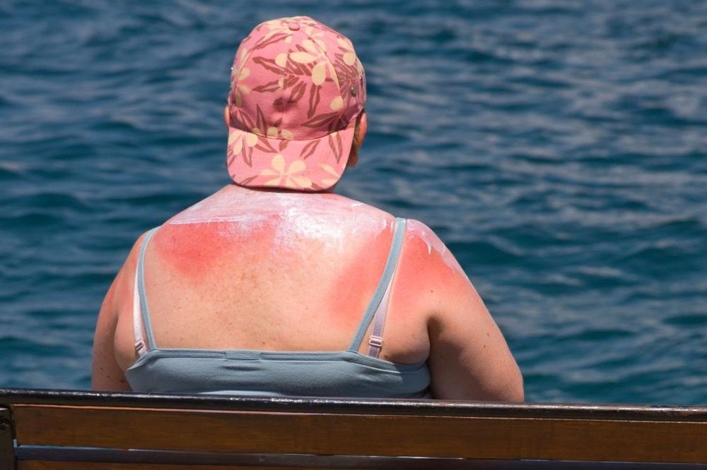 Ako izgorite na suncu, ne stavljajte jogurt ili kiselo mleko! To je najgora stvar, evo šta zaista pomaže - featured image